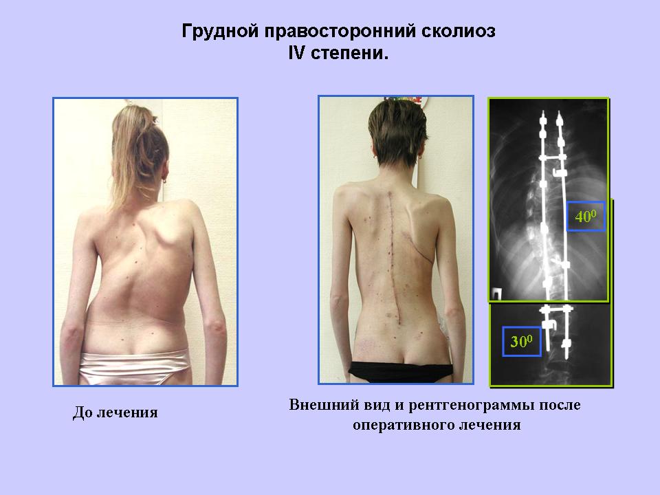 Арзамас корректор осанки
