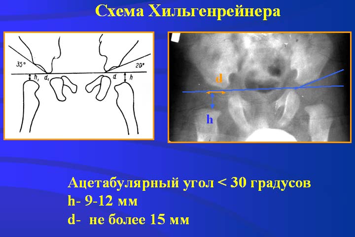 Схема рейнберга врожденный вывих бедра